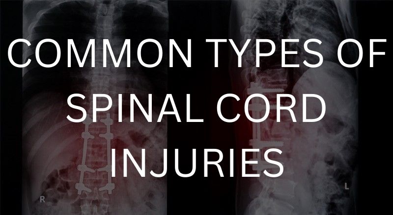 Common types of spinal cord injuries